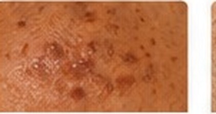 Melasma