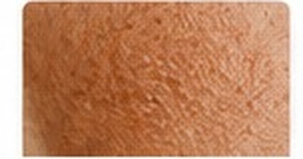 Post-Inflammatory Hyperpigmentation (PIH)