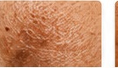 Sun Spots (Solar Lentigines)