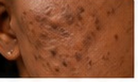 Post-Inflammatory Hyperpigmentation (PIH)