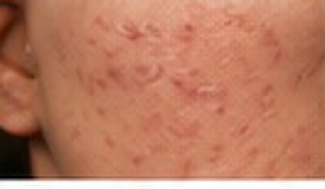 Post-Inflammatory Erythema (PIE)