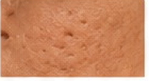 Atrophic Acne Scars