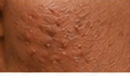 Hypertrophic & Keloid Scars