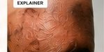 Hyperpigmentation Explained