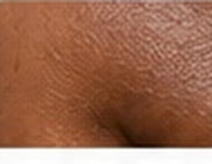 Hyperpigmentation