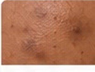 Dark Spots