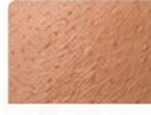 Keratosis Pilaris