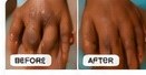 Dark knuckles before and after