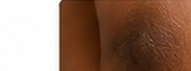 Frictional Hyperpigmentation