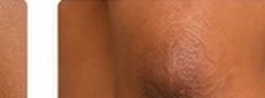 Post-Inflammatory Hyperpigmentation (PIH)