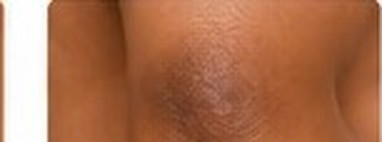 Sun-Induced Pigmentation