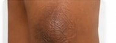 Generalised Hyperpigmentation