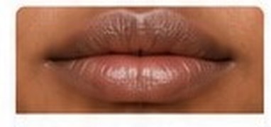 Patchy Pigmentation