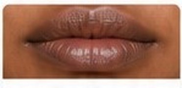 Smoker's Lip Discolouration