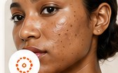 Face & Body Hyperpigmentation