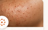 Rough Bumpy Skin