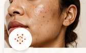 Acne & Blemishes