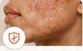 Hypopigmentation & Damaged Skin Barrier
