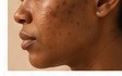 Post-Inflammatory Hyperpigmentation (PIH)