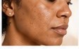 Melasma