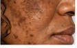 Sun Spots (Solar Lentigines)