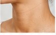 Hormonal Hyperpigmentation