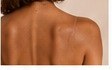 Body Hyperpigmentation