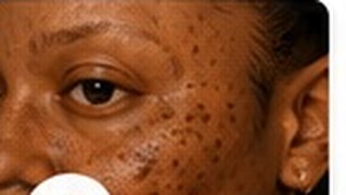 Hyperpigmentation