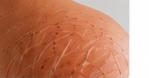 Stretch Marks
