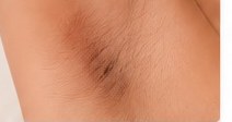 Underarm Pigmentation