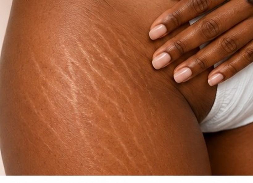 Stretch marks on skin