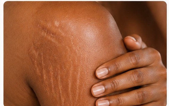 Close-up of shoulder with stretch marks