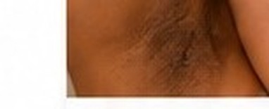 Post-Inflammatory Hyperpigmentation (PIH)