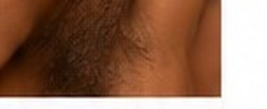 Hormonal Pigmentation