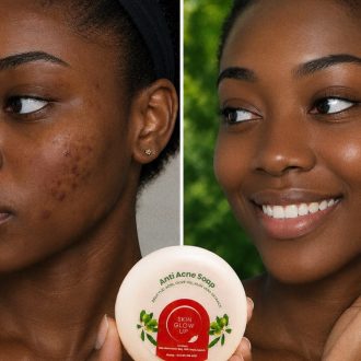 Anti Acne Soap