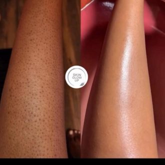 Keratosis Pilaris Skin (KP/Chicken Skin)
