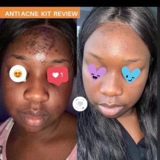 Anti-acne Face Kit