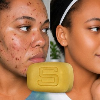 Acne-treatment Sulfur Soap